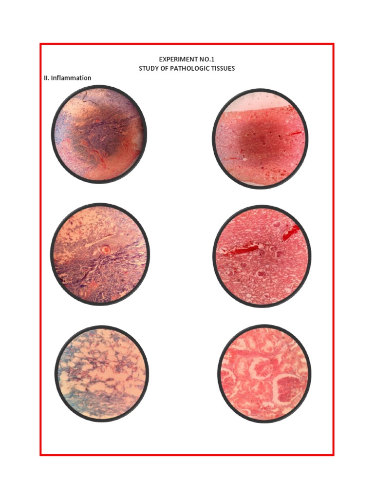 Study of Inflammation and Neoplasia | PDF