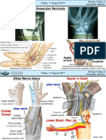 Scaphoid Fracture & Avascular Necrosis: Friday, 11 August 2017