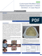 Customized Modified Haas Palatal Expansion in Mixed Dentition: A Case Report