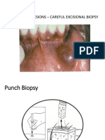 For Mucocele Lesions - Careful Excisional Biopsy
