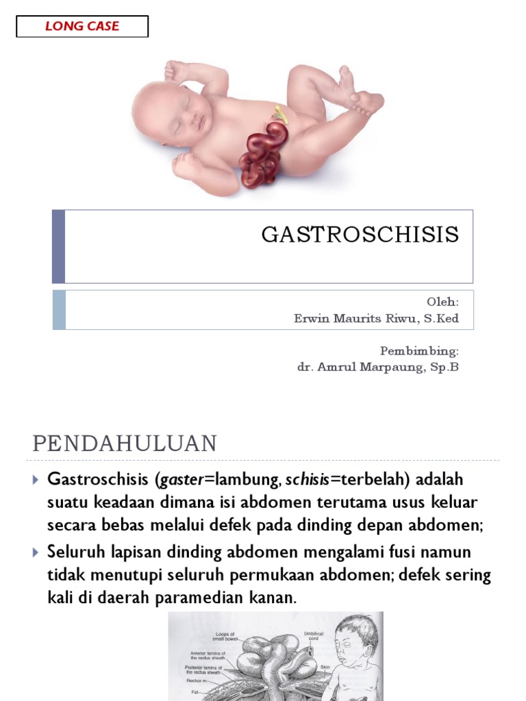 Gastroschisis