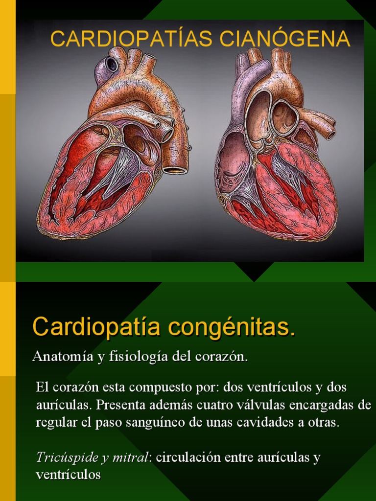 Cardiopatia Congenita Cianogena Mas Frecuente