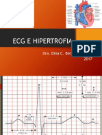 Ecg e Hipertrofia