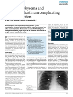 Surgical Emphysema and Pneumomediastinum Complicating Dental Extraction