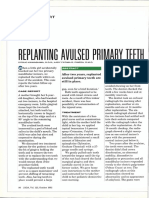 Replanting Avulsed Primary Teeth: Case Report