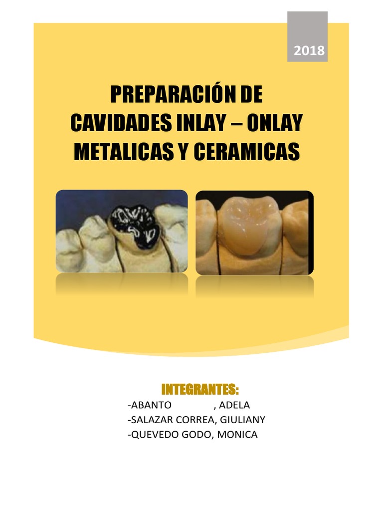 Preparación de incrustaciones dentales inlay-onlay metálicas y ...
