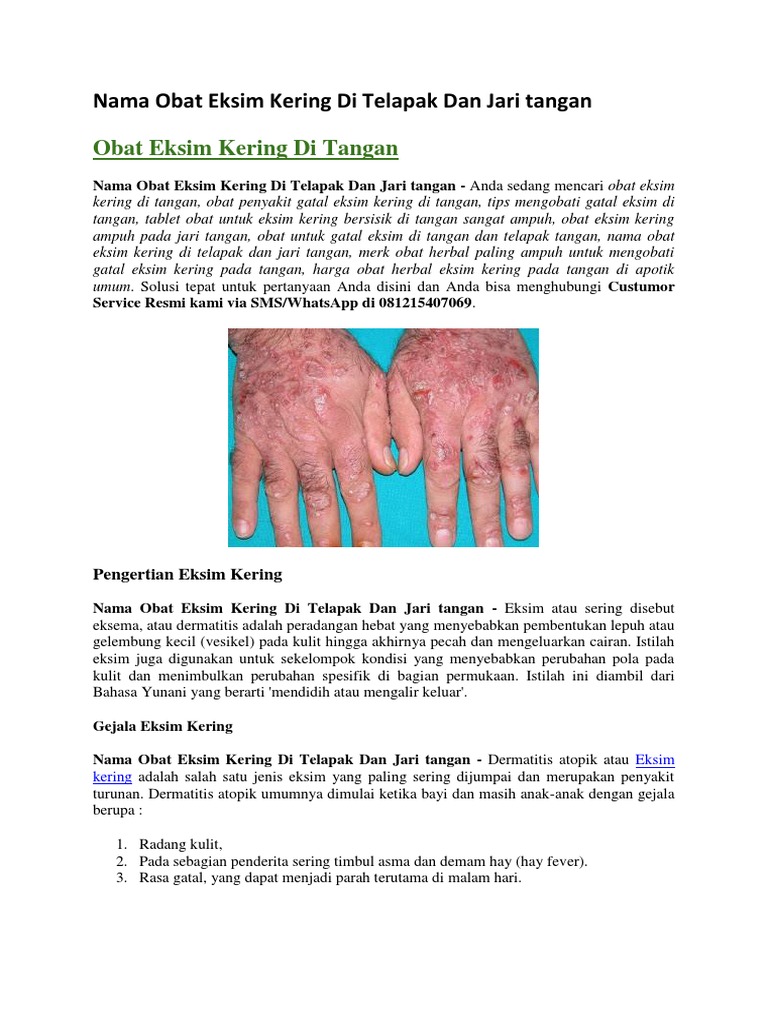  Nama  Obat Eksim Kering Di  Telapak Dan Jari  Tangan 