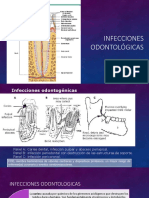 Absceso Odontogenico