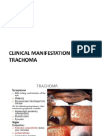 Clinical Manifestation of Trachoma