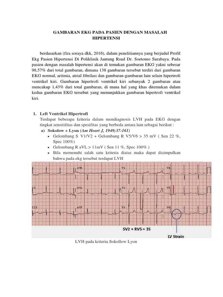 Gambaran Ekg Pada Pasien Dengan Masalah Hipertensi | PDF