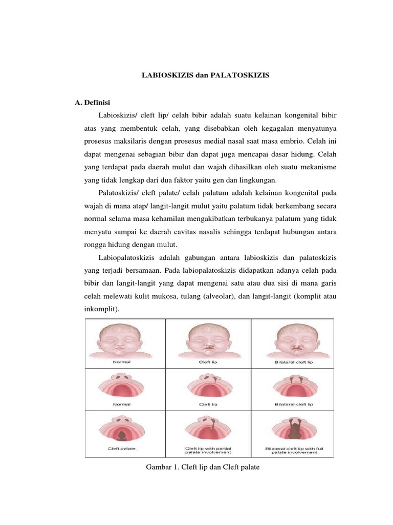 Labiopalatoskizis: Definisi dan Tatalaksana | PDF