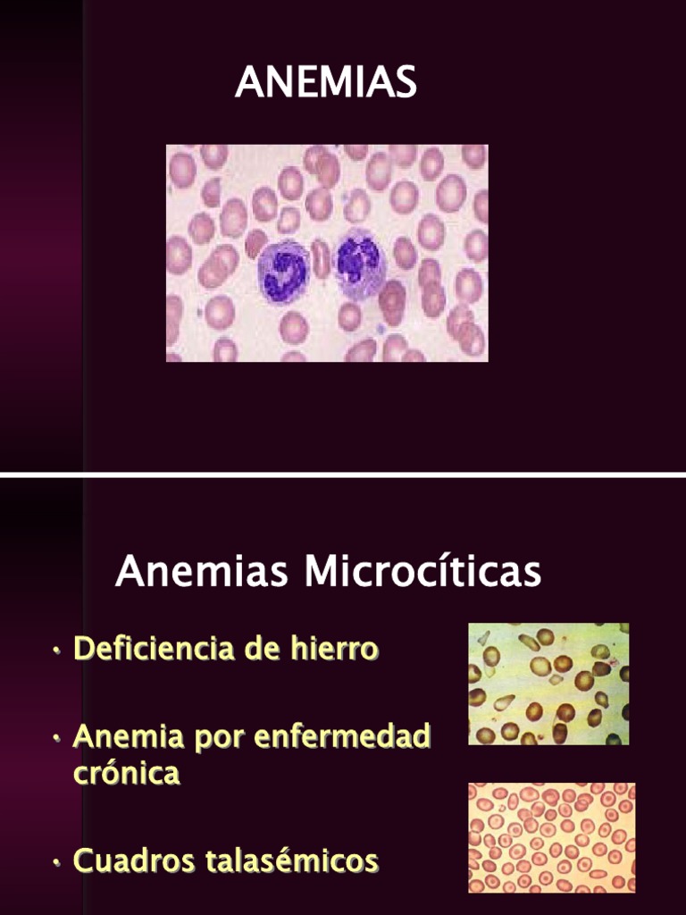 Anemias Vcm Vitamin B12 Anemia