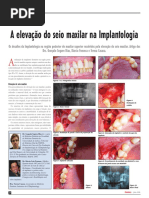 A ELEVAÇÃO DO SEIO MAXILAR NA IMPLANTOLOGIA-httpwww.ceimplantology.comdownloadsarticlesESeio Dentistry.pdf