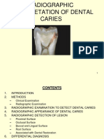 Radiographic Interpretation of Dental Caries - Dental Ebook & Lecture Notes PDF Download (Studynama - Com - India's Biggest Website For BDS Study Material Downloads)