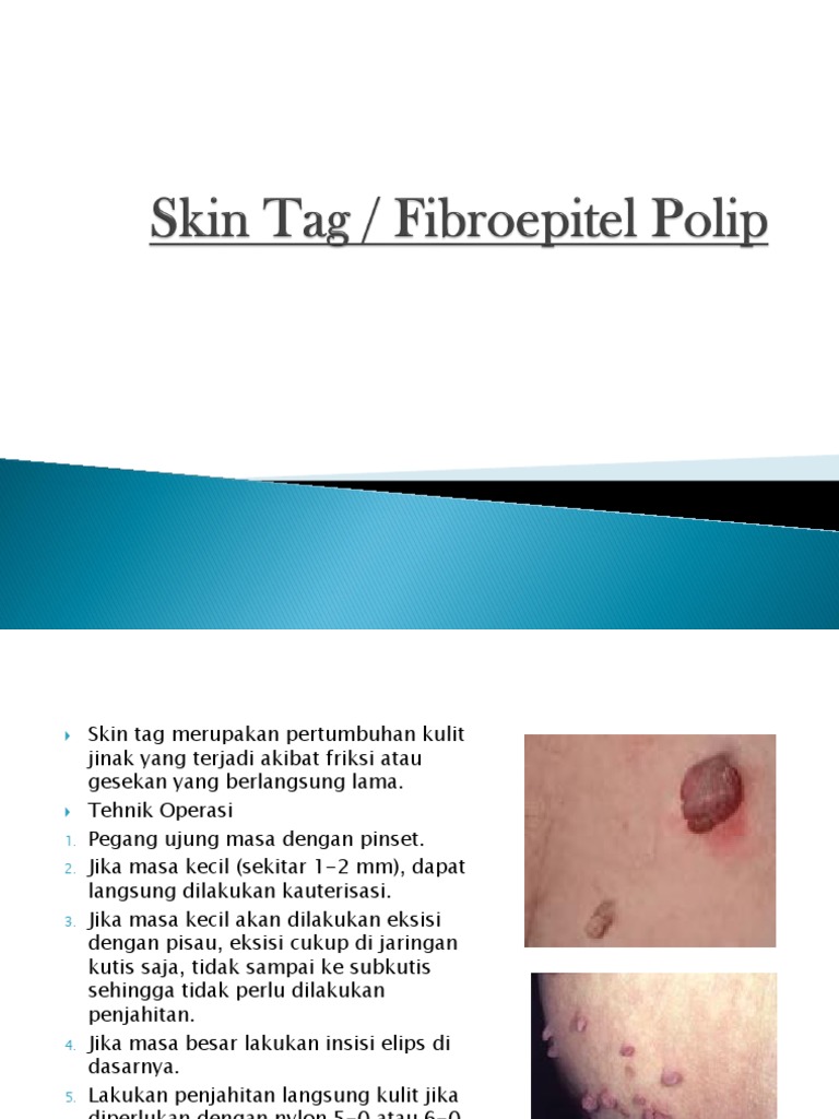Eksisi dan Penanganan Skin Tag | PDF | Ilmu Sosial | Sains & Matematika