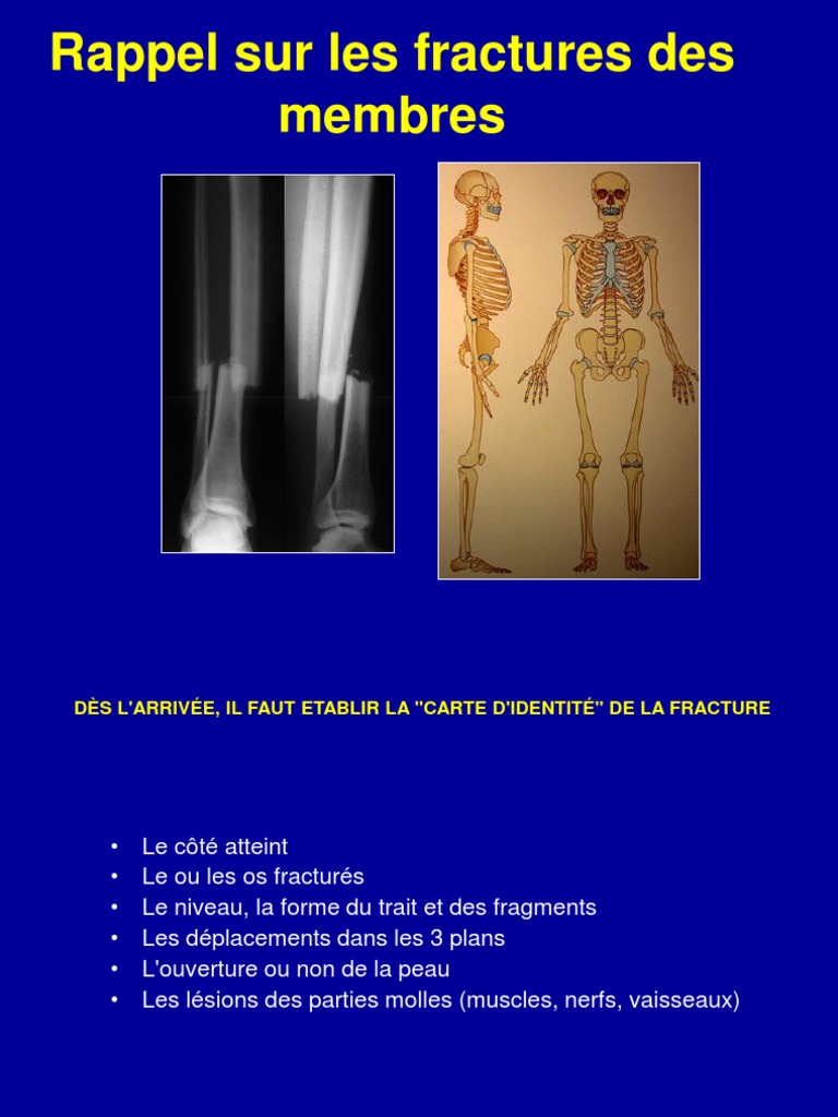 1-Fractures Generalites | PDF | Os | Système squelettique