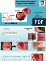 Ulcera péptica: causas, síntomas y tratamiento