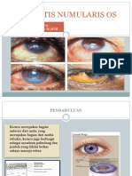 Keratitis Numularis Os-1