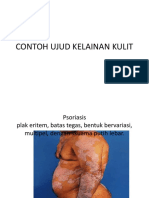 CONTOH UJUD KELAINAN KULIT.pptx