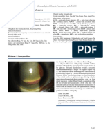 Meta-analysis of genetic links to PACG