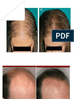 alopeciaa.pdf