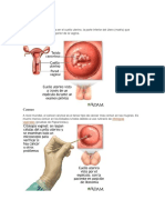 Cáncer Cervical