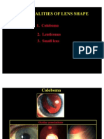 Abnormal Lens Shape