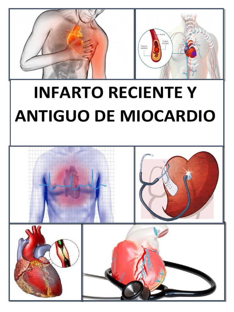 Infarto de Miocardio: Reciente y Antiguo | PDF | Infarto de miocardio ...