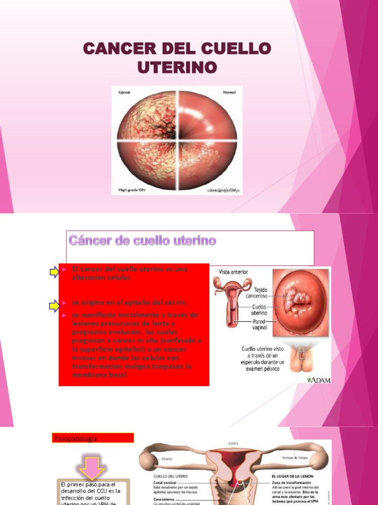 Cancer de Cuello Uterino Cáncer de pulmón Cáncer de cuello uterino