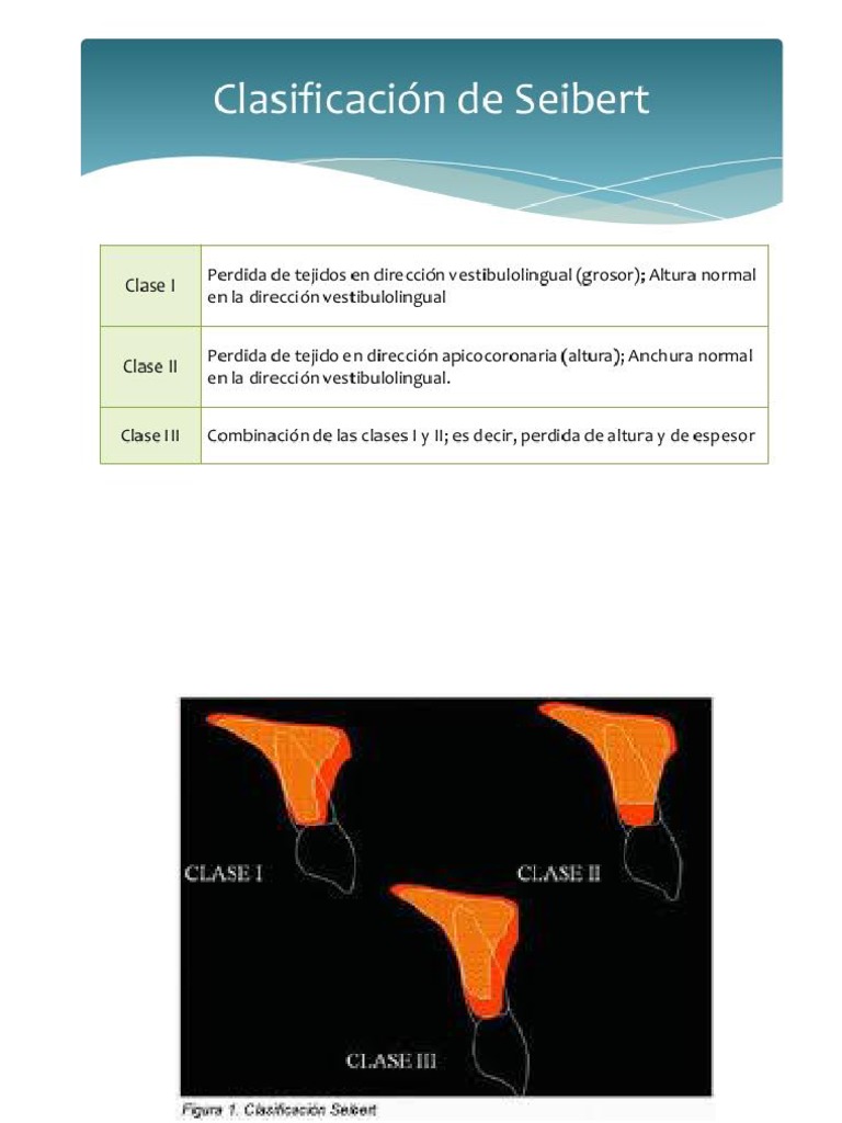 clasificaciones-de-reabsorcion-en-procesos-alveolares-pdf