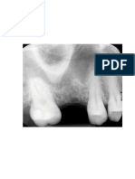 Surgial Technique Sinu Lift System