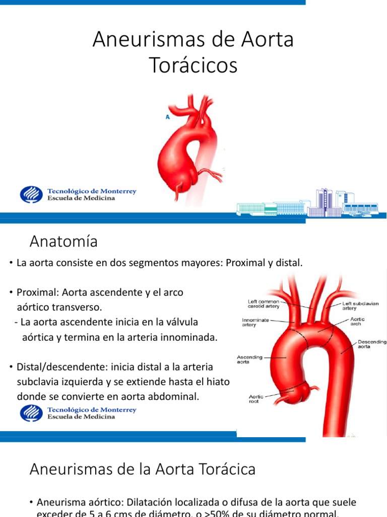 Aneurismas de Aorta Torácica: Anatomía y Tratamiento | PDF | Aorta ...