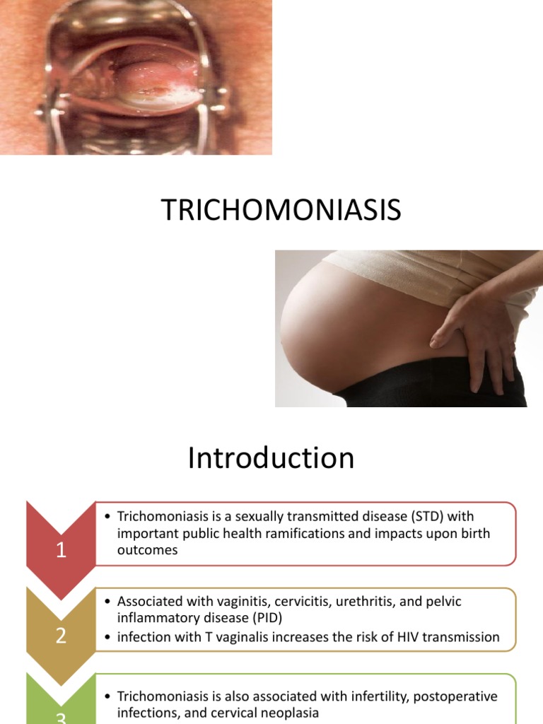 TRICHOMONIASIS Sexually Transmitted Infection Human Sexuality