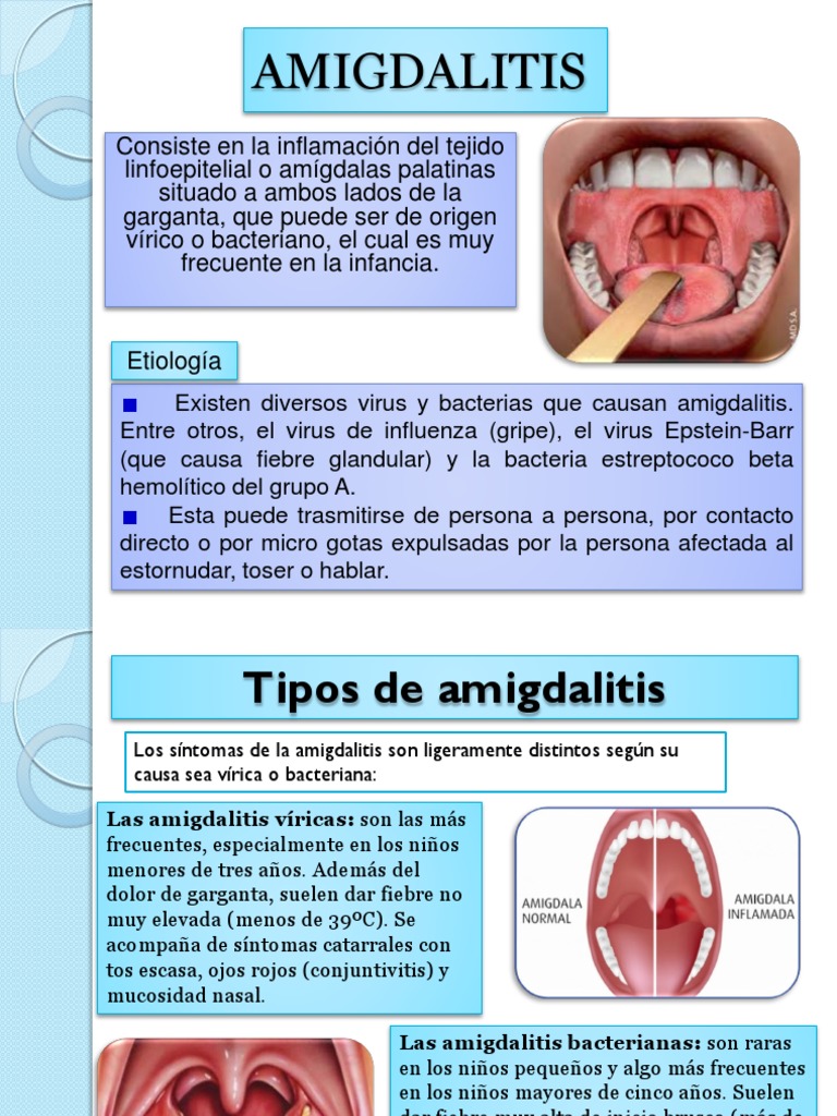 amigdalitis, faringitis, parotiditis | Epidemiología | Especialidades ...