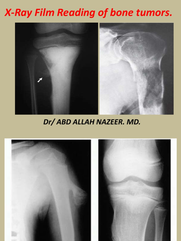 X Rayfilmreadingforbonetumour 170823234853 | PDF | Bone | Skeletal System