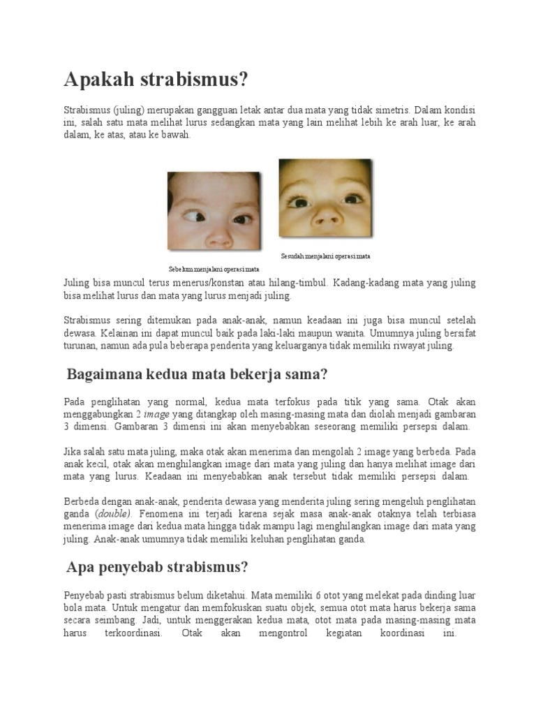 Apakah Strabismus Apakah Strabismus