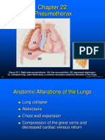 Pneumothorax: Figure 22-1. Right-Side Pneumothorax. GA, Gas Accumulation DD, Depressed Diaphragm