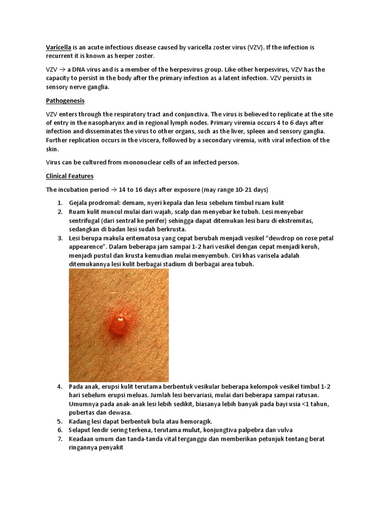 Varicella