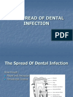 The Spread of Dental Infection
