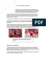 Colocación Del Implante PPR