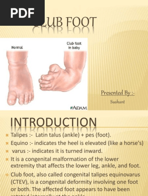 Clubfoot Pdf Pied Medecine Clinique