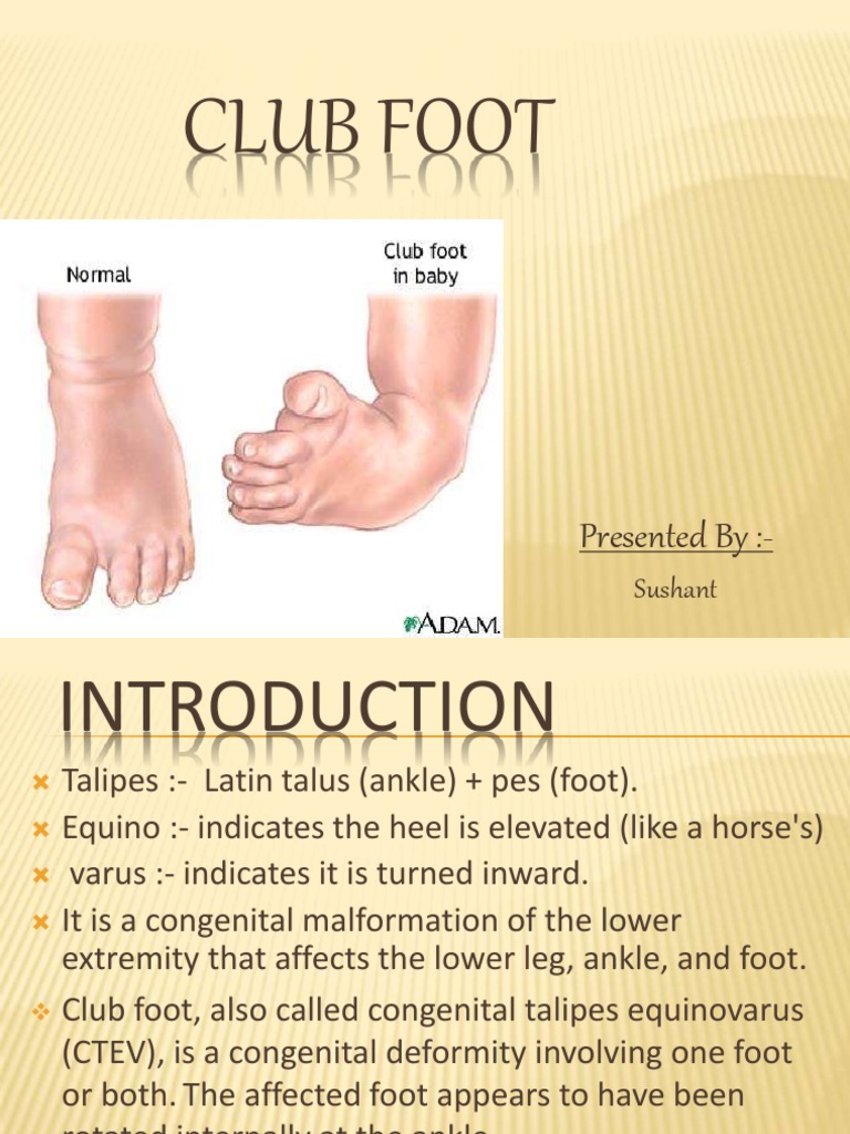 Clubfoot Pdf Pied Medecine Clinique