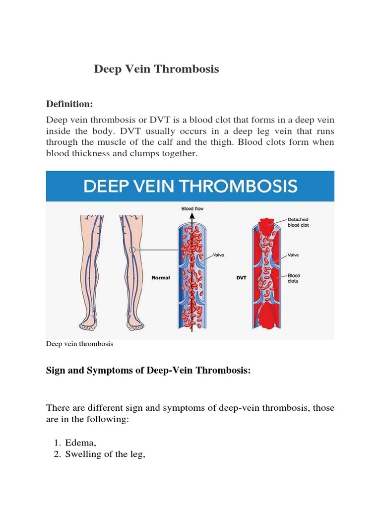 Deep Vein Thrombosis | PDF | Thrombosis | Vein