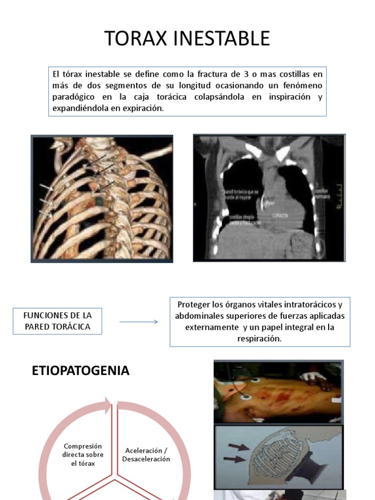 Definición y manejo del tórax inestable | PDF | Tórax | Lesión