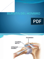 Bursitis Del Hombro