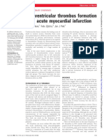 Left Ventricular Thrombus Formation After Acute Myocardial Infarction