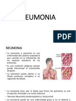 Neumonia