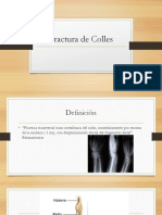Fractura de Colles: Guía completa sobre su definición, clasificación y tratamiento
