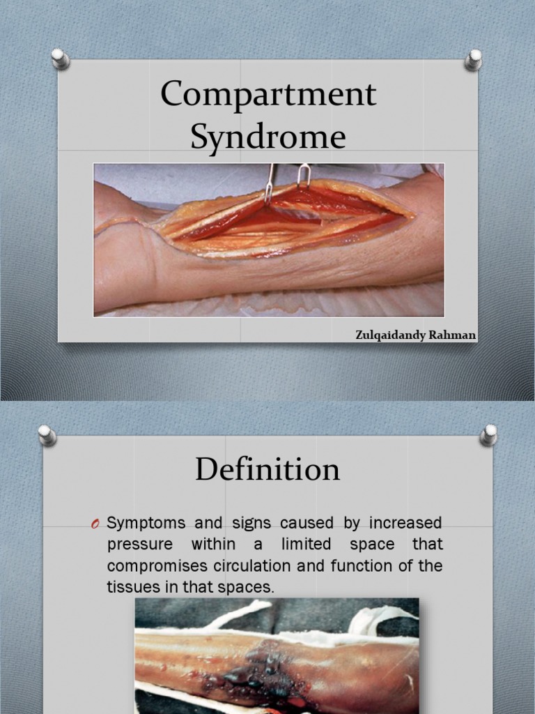 Understanding Compartment Syndrome | PDF | Clinical Medicine | Medical ...