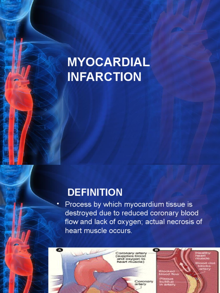 2myocardial Infarction | PDF | Myocardial Infarction | Cardiovascular ...